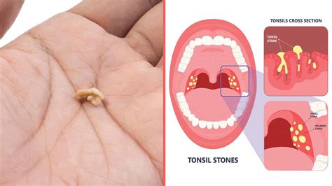 Tonsil Stones Cause