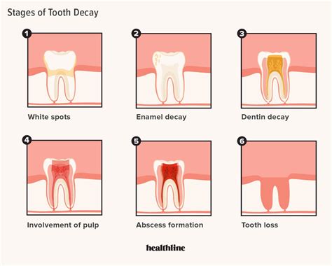 Tooth Decay Stages