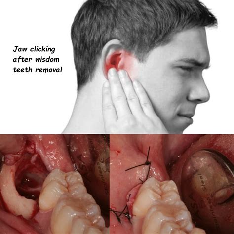 Toothache After Tooth Pulled