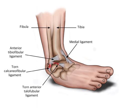 Torn Ligament In Ankle