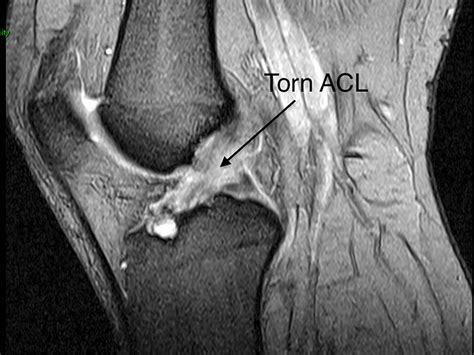 Torn Ligament In Knee