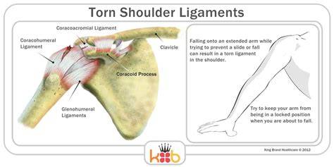 Torn Shoulder Ligaments