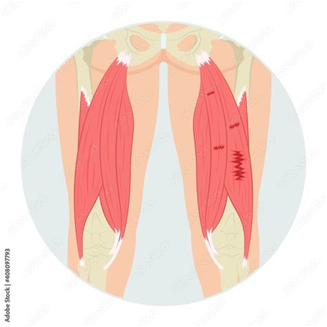 Torn Thigh Muscle