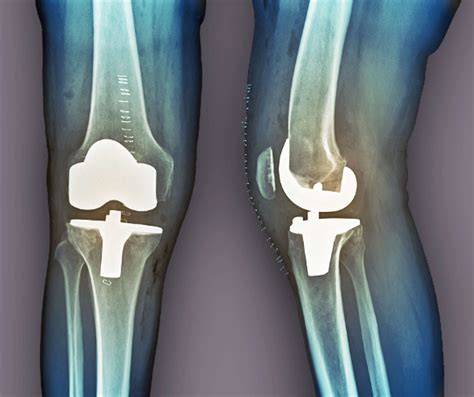 Total Knee Replacement Surgery Video