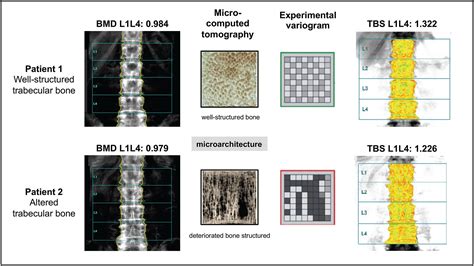 Trabecular Bone Score