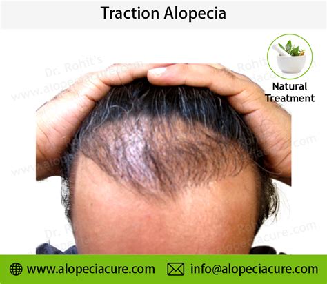 Traction Alopecia Remedy