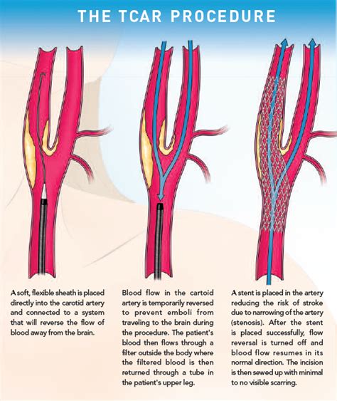 Transcarotid Artery Revascularization
