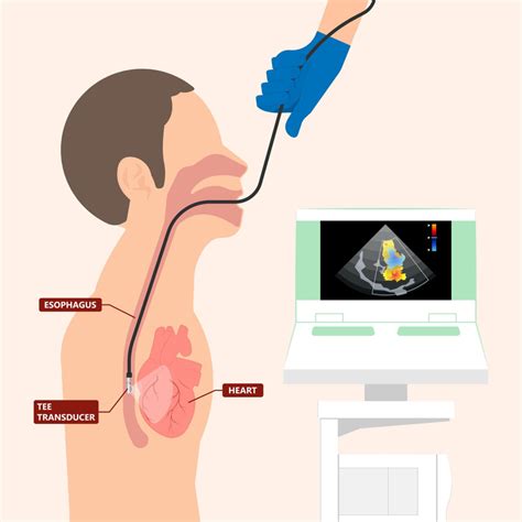 Transesophageal Echocardiogram Tee