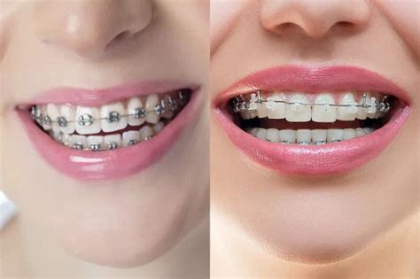 Transparent Braces Vs Metal