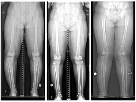 Treatment Blount's Disease