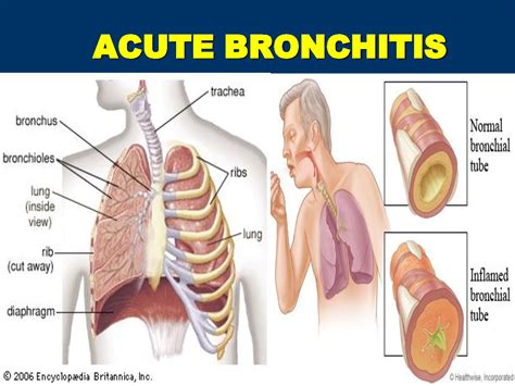 Treatment For Bronchitis In Adults