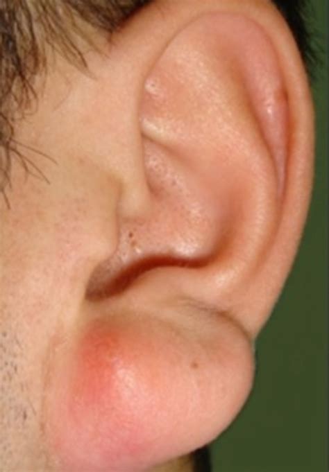 Treatment For Earlobe Cyst