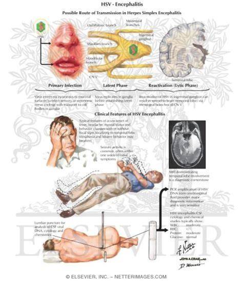 Treatment For Herpes Encephalitis