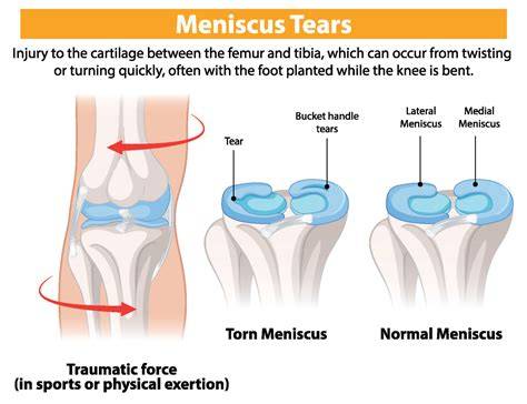 Treatment For Meniscus Tear