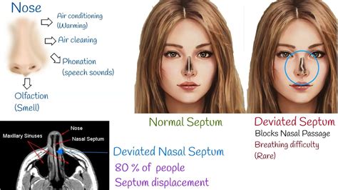 Treatment For Nasal Septum Deviation