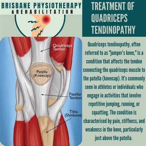 Treatment For Quadriceps Tendinopathy