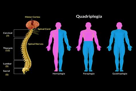 Treatment For Quadriplegia