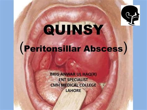Treatment For Quinsy Nhs