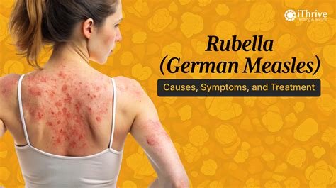 Treatment For Rubella