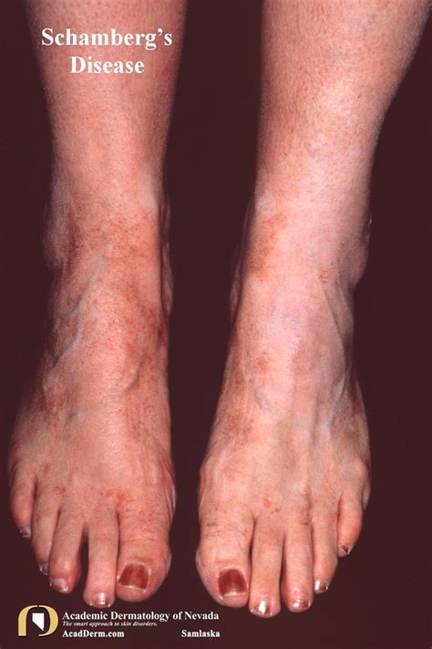 Treatment For Schamberg's Disease