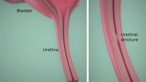 Treatment For Stricture In Urethra