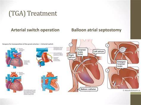 Treatment For Tga