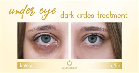 Treatment For Under Eye Dark Circles