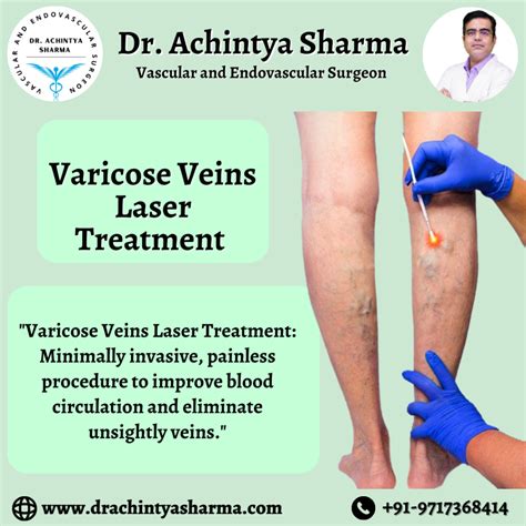 Treatment For Varicose Vein