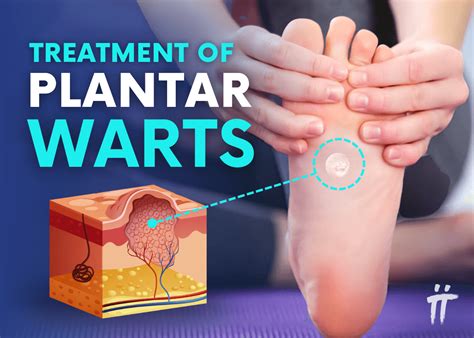 Treatment For Warts