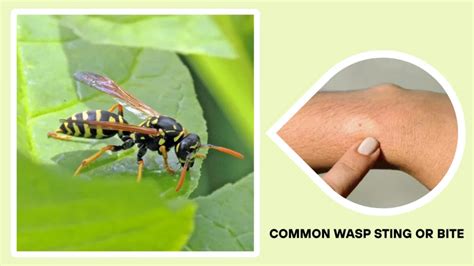 Treatment For Wasp Bite