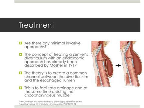 Treatment For Zenker's Diverticulum
