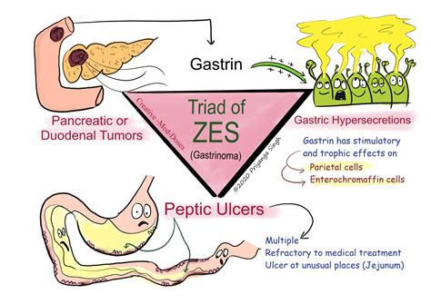 Treatment For Zes