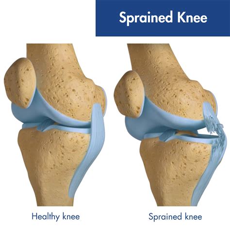 Treatment Knee Sprain