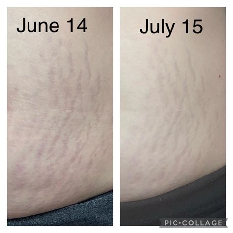 Tretinoin Stretch Marks