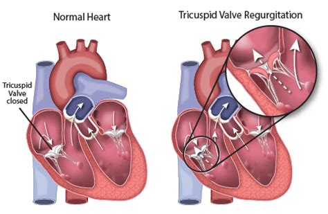 Tricuspid Valve Regurgitation