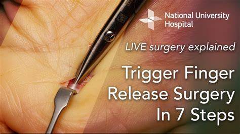 Trigger Finger Surgery Recovery
