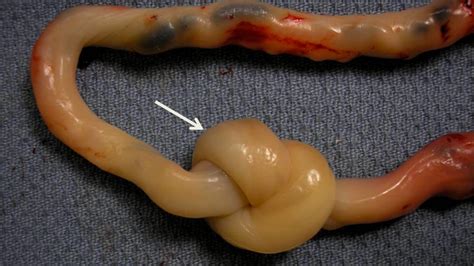 True Knot In Umbilical Cord