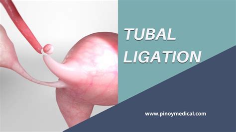 Tubal Ligation Cost