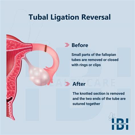 Tube Tied Reversal