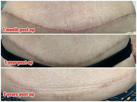 Tummy Tuck Recovery