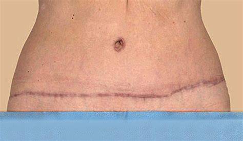 Tummy Tuck Scar