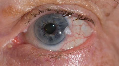 Tumor In Eye Treatment