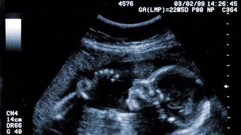 Twenty Week Scan