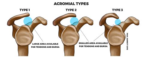 Type Ii Acromion
