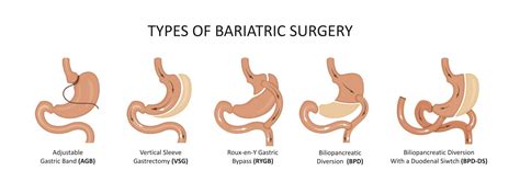Types Of Bariatric Surgery