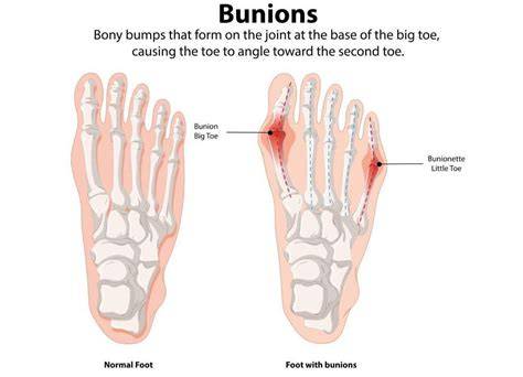 Types Of Bunion Operations