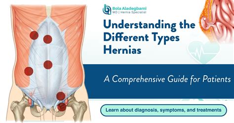 Types Of Hernias In Women