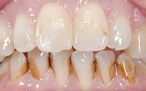 Types Of Teeth Stains
