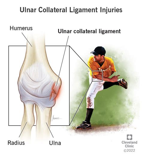 Ucl Tear Recovery Time