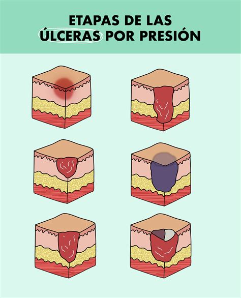 Ulceras Por Presion